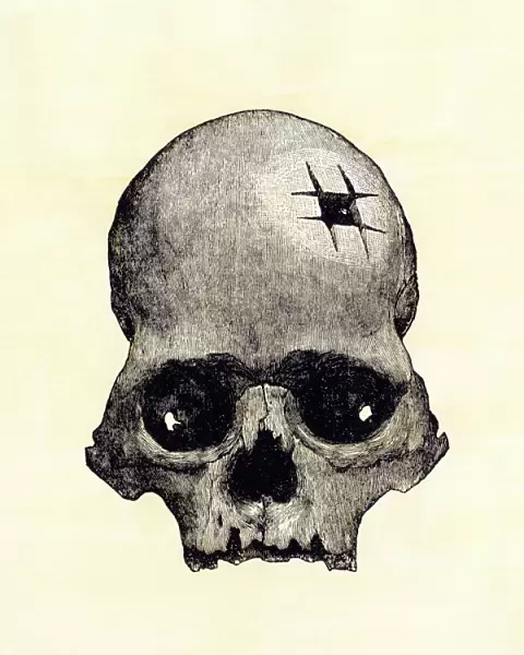 Trephination evidence in an Inca skull